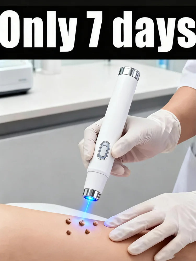 Blue Light Wart Remover Tool